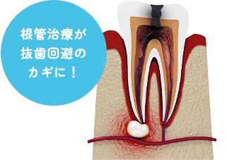 根管治療が抜歯回避のカギに！