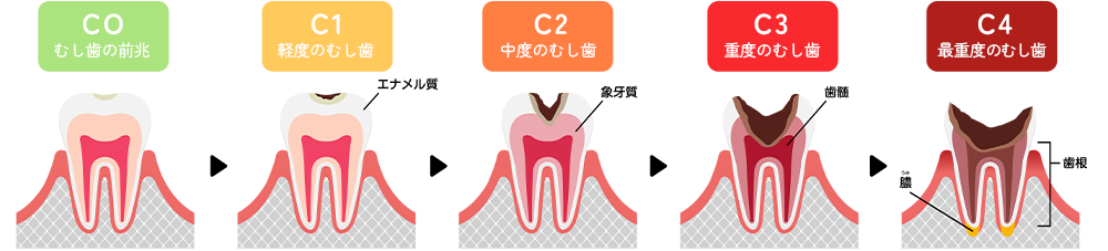 むし歯の進行度 C1~C5