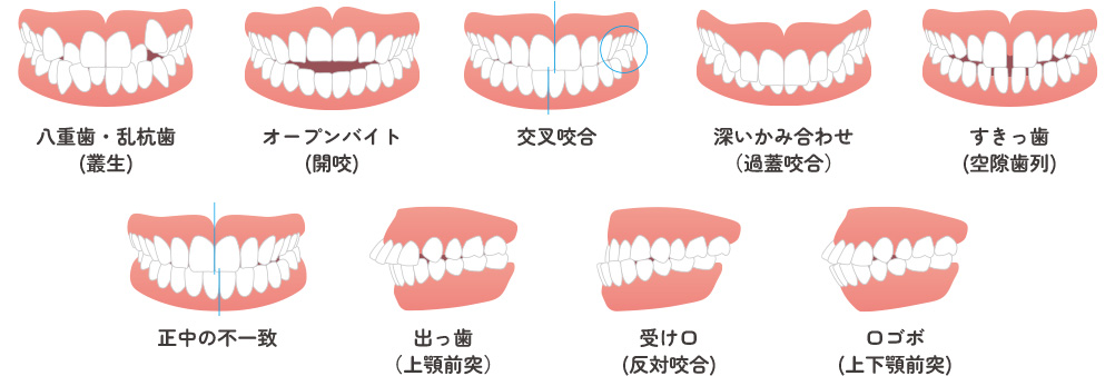 不正咬合の種類